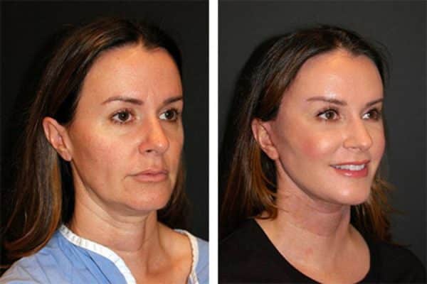 non-surgical-facelift-essex-barstable-medical-clinic