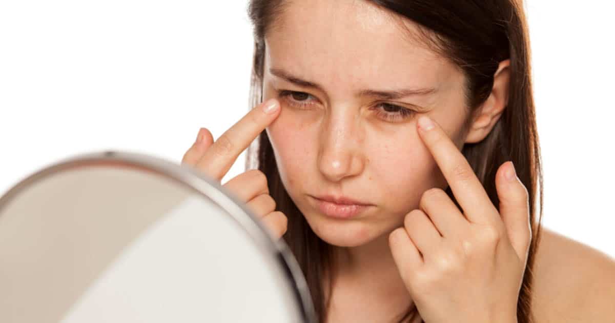 Dark Circles Treatment - 3D Lifestyle Pakistan