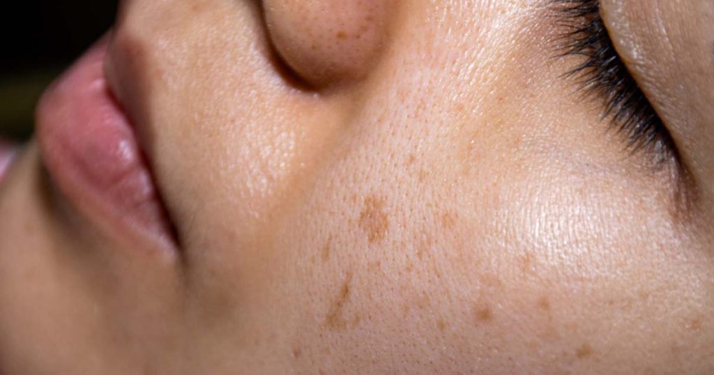 Skin Tone Problem What is Uneven Skin Tone? 3 Ways To Fix It. 3D Lifestyle PK