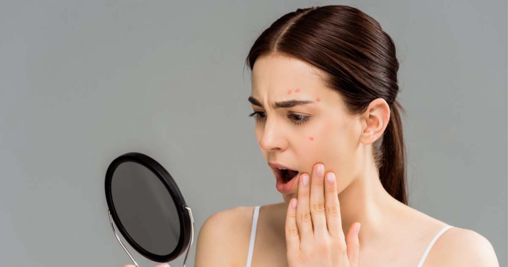 How Acne Works: Everything You Need To Know & How To Treat It 3D ...