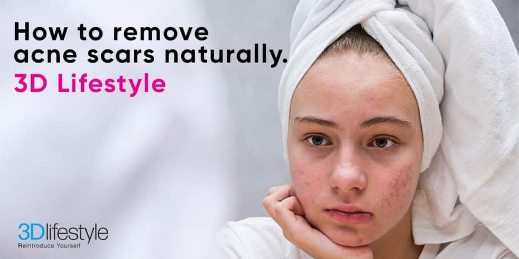 How to Remove Acne Scars Naturally | 3D Lifestyle