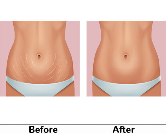 belly hair removal