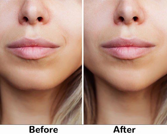 uper lips hair removal