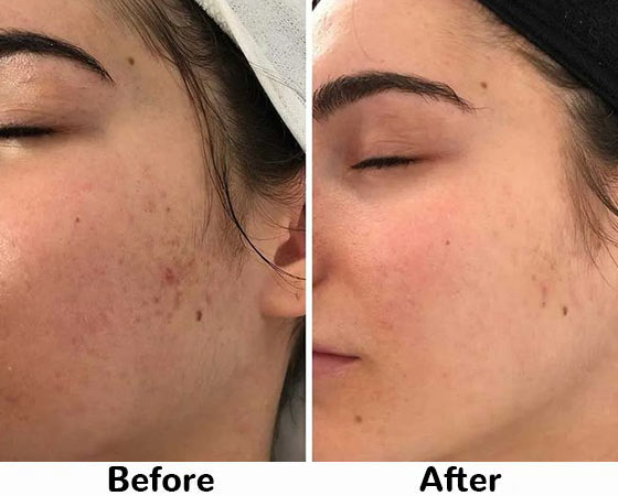 Hydrafacial before and after 4