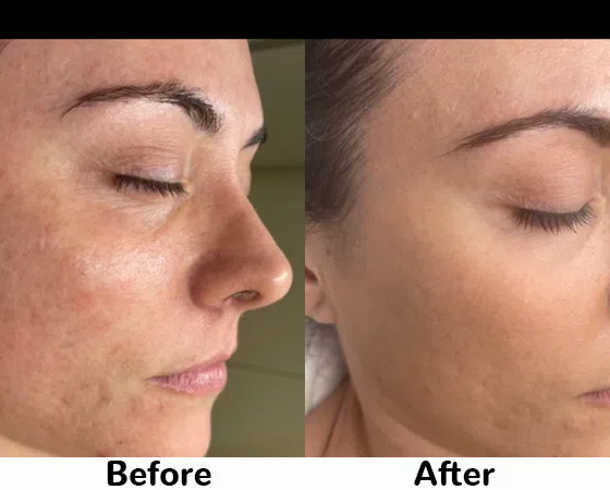 Hydrafacial before and after 3