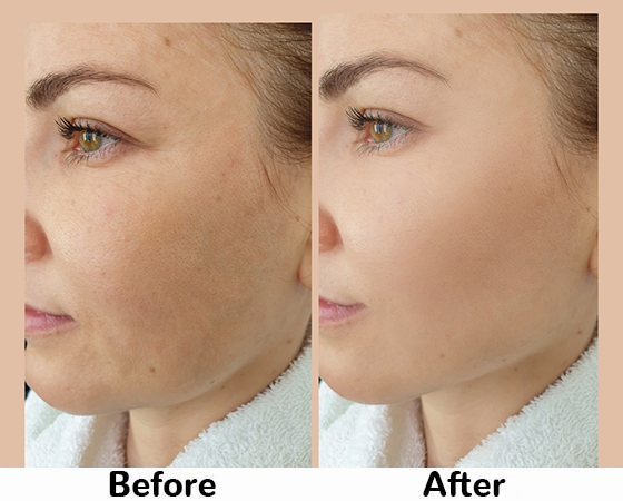 Hydrafacial before and after 2