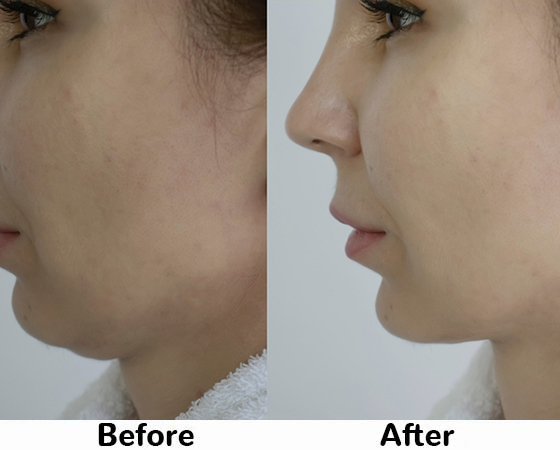 Hydrafacial before and after 1