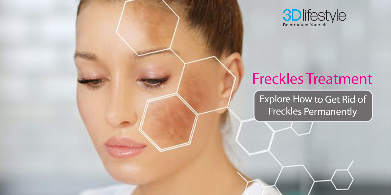 Freckles Treatment