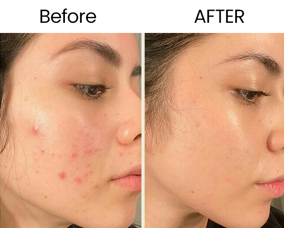 3D ClearSkin Peel