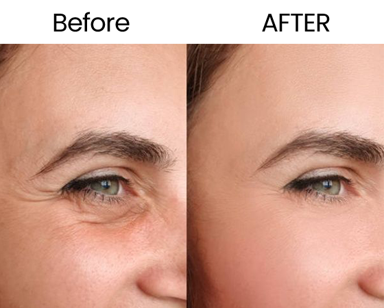 3D ClearSkin Peel 4