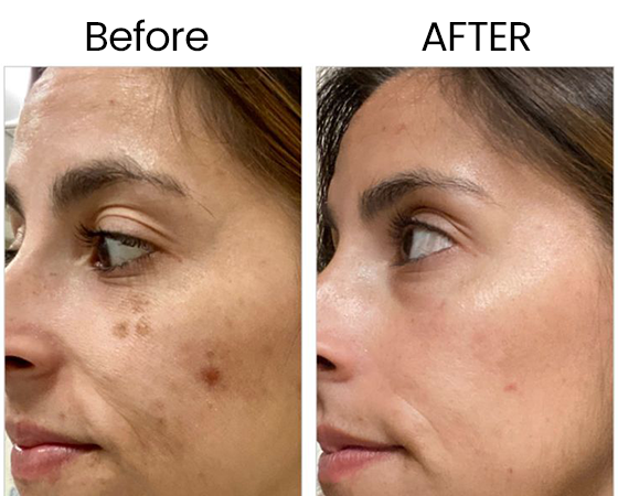 3D ClearSkin Peel