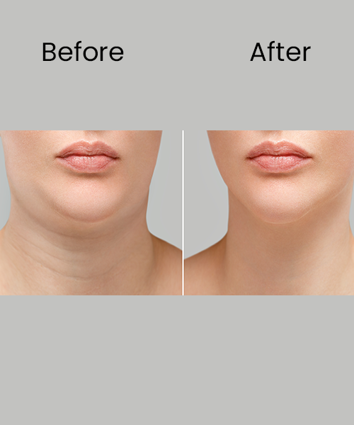 double chin after .before