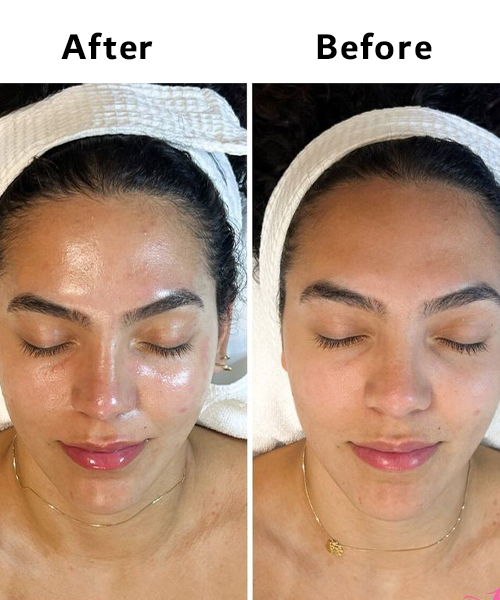 Red carpet collagen facial