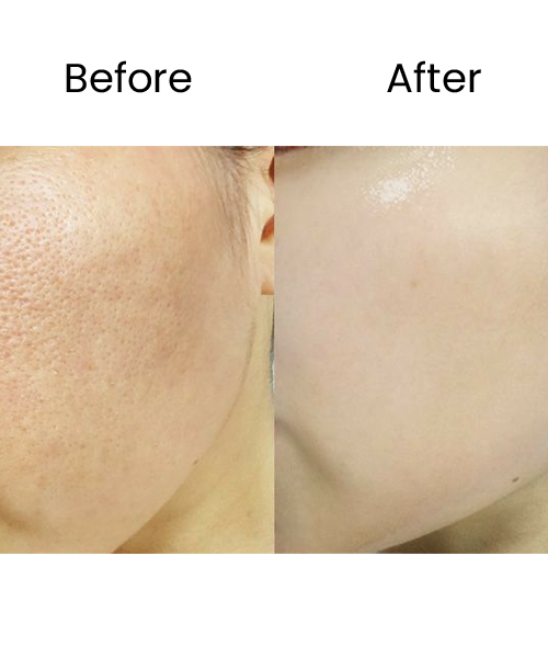 chemical peel before after