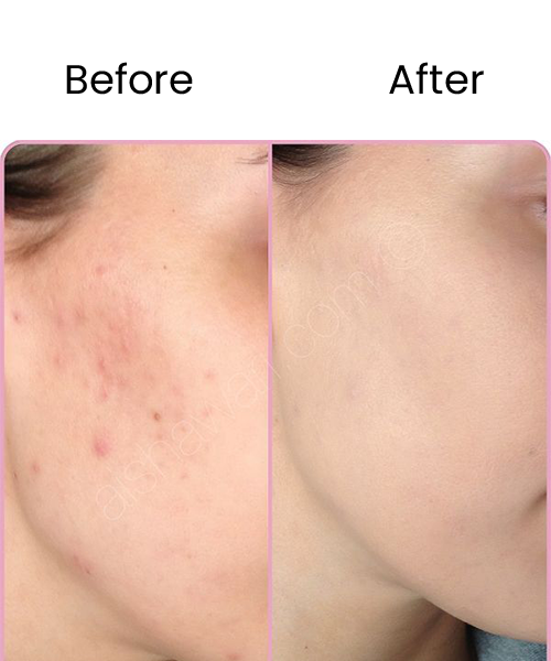 chemical peel before after