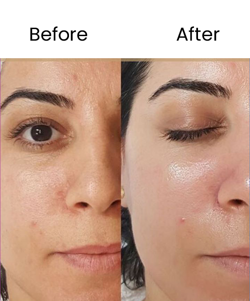 chemical peel before after