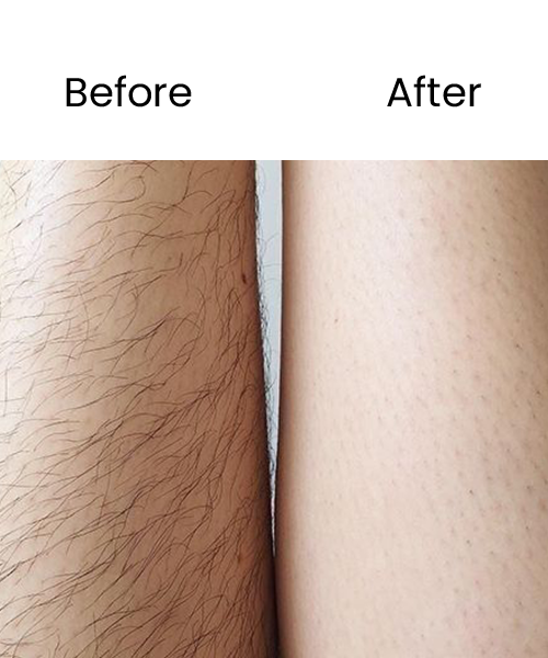 hair removal before after