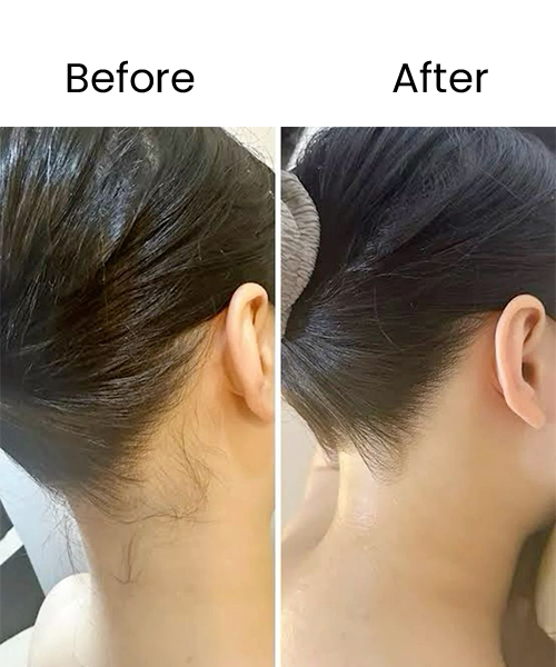 hair removal before after