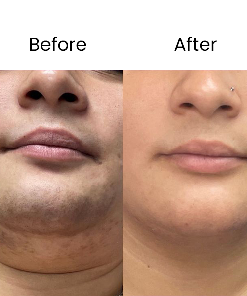 double chin before after