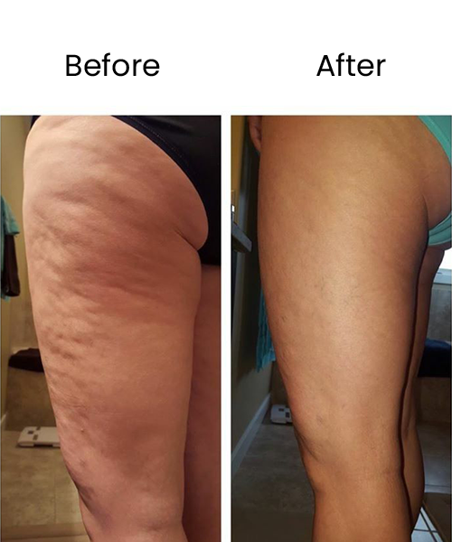 thigh fat reduction