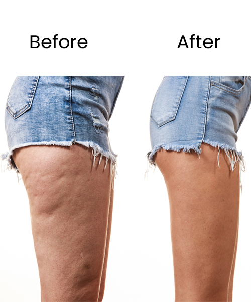 thigh fat reduction