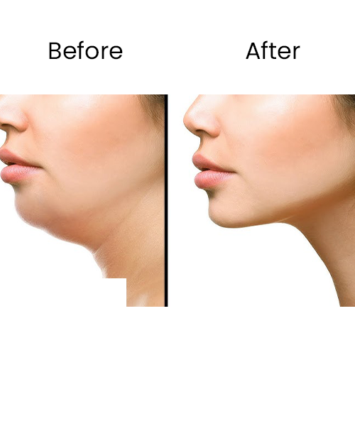 double chin after .before