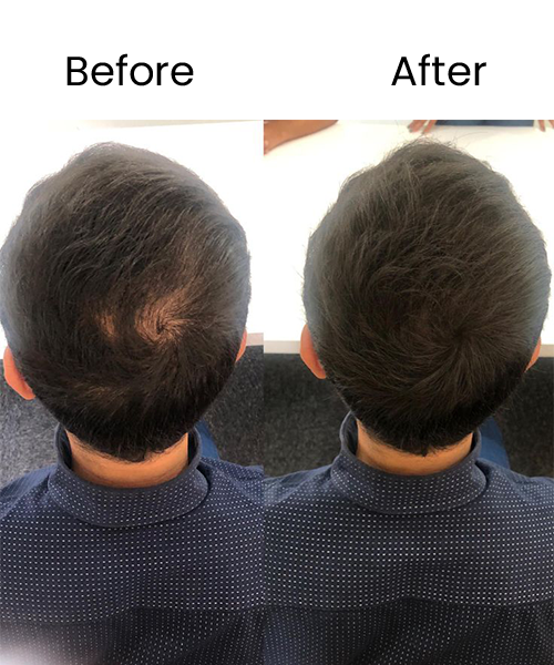 hair prp treatment before after