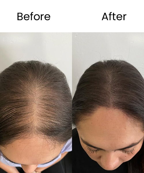 hair prp before after