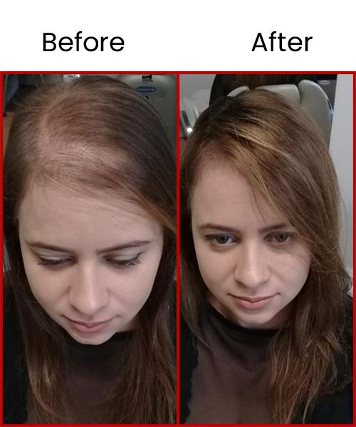 hair prp before after