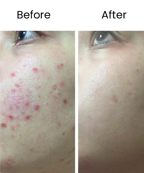 face prp treatment before after