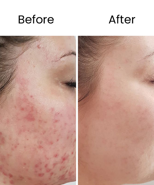 face prp treatment before after