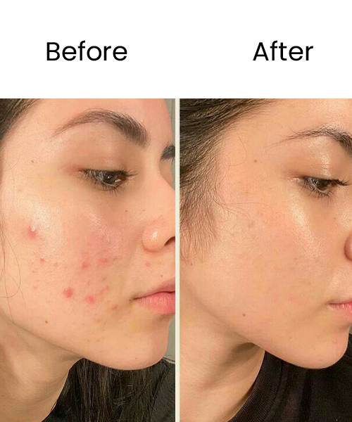 face prp treatment before after