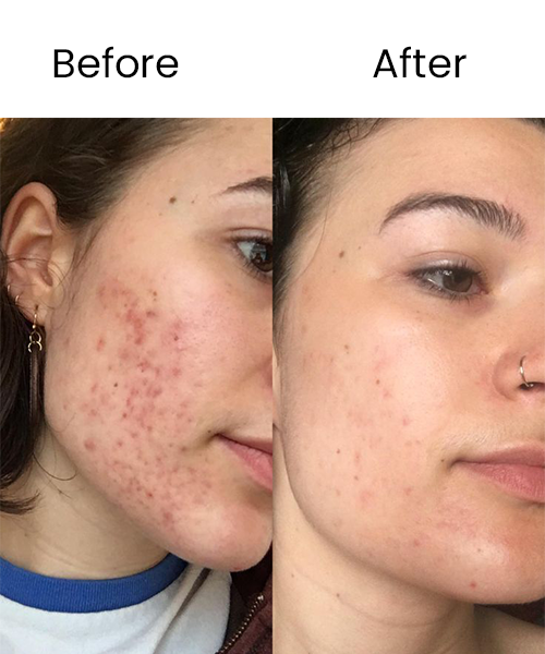 face prp treatment before after