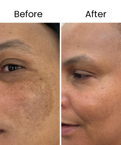 face prp treatment before after