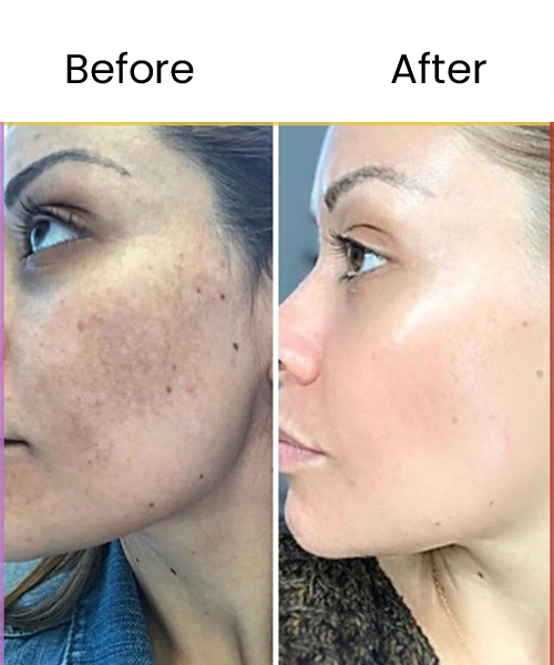 face prp treatment before after