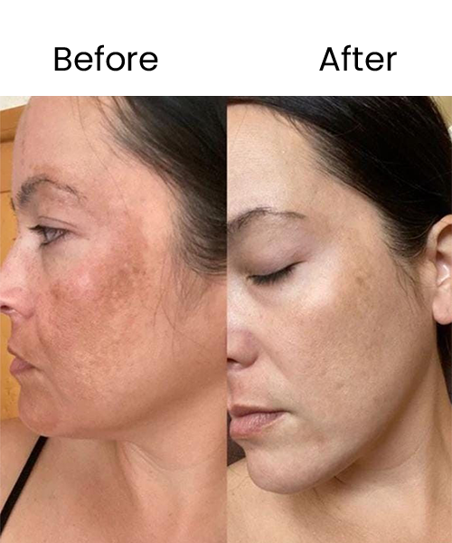 face prp treatment before after