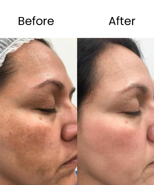 face prp treatment before after