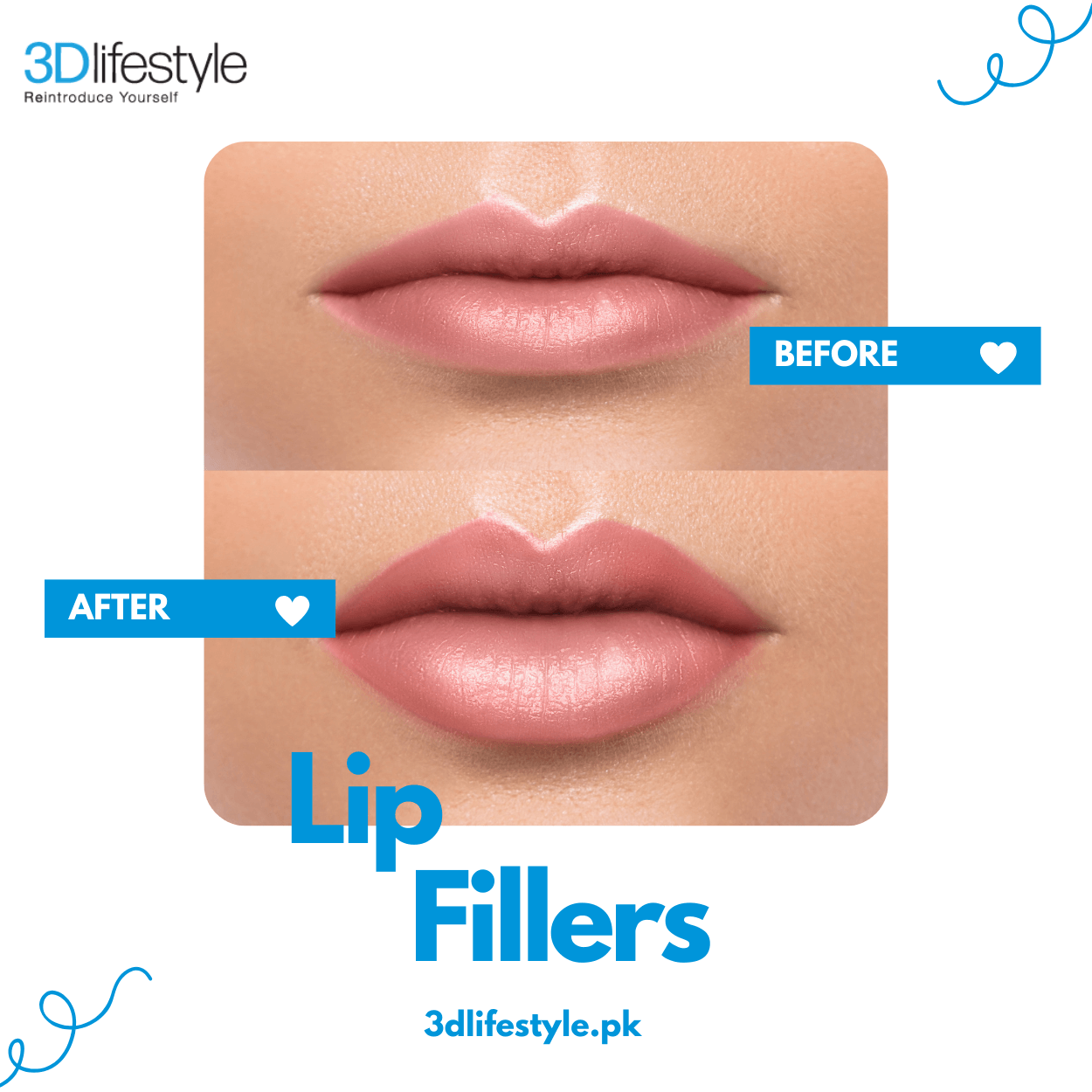 lip filler before after