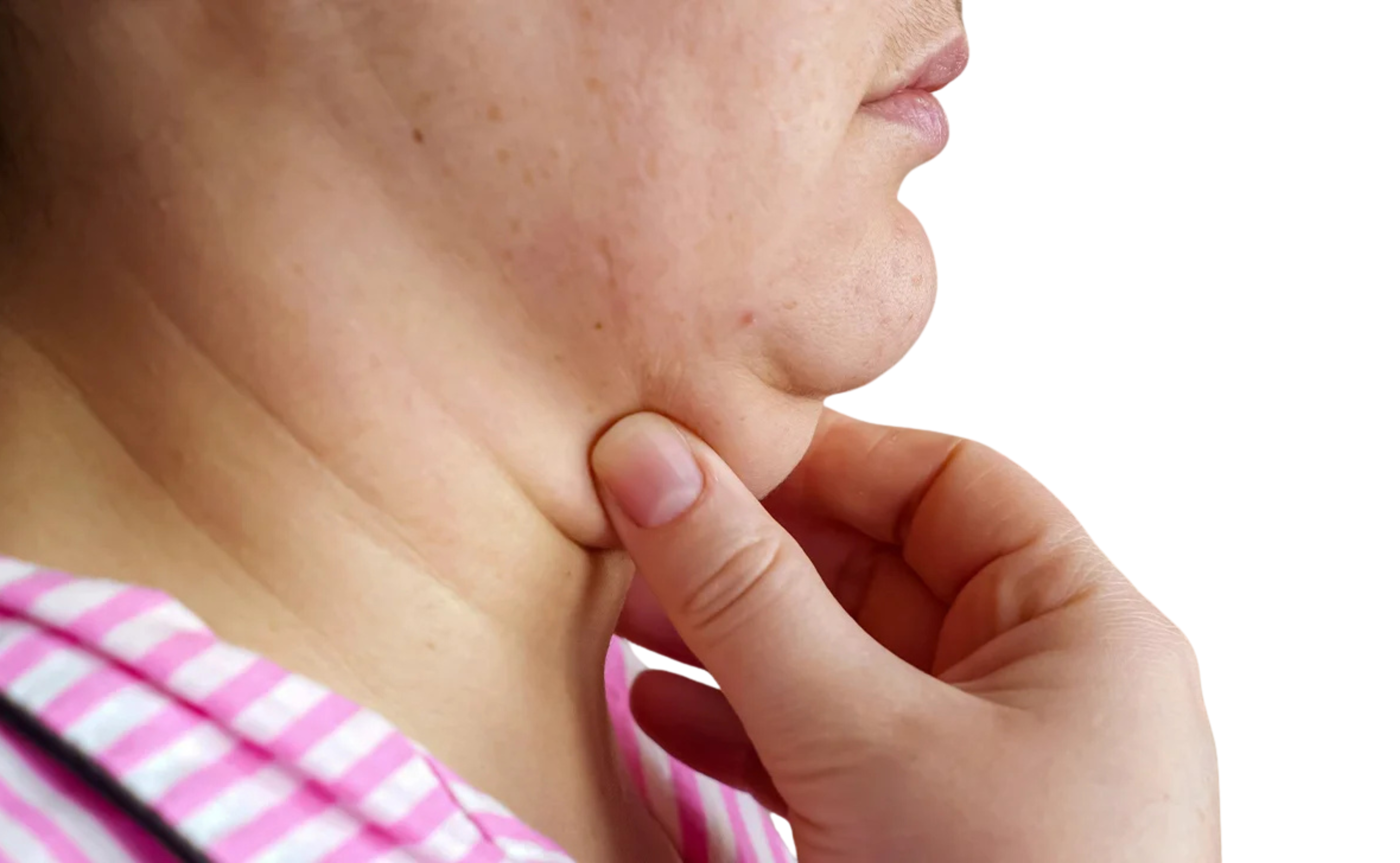 double chin removal