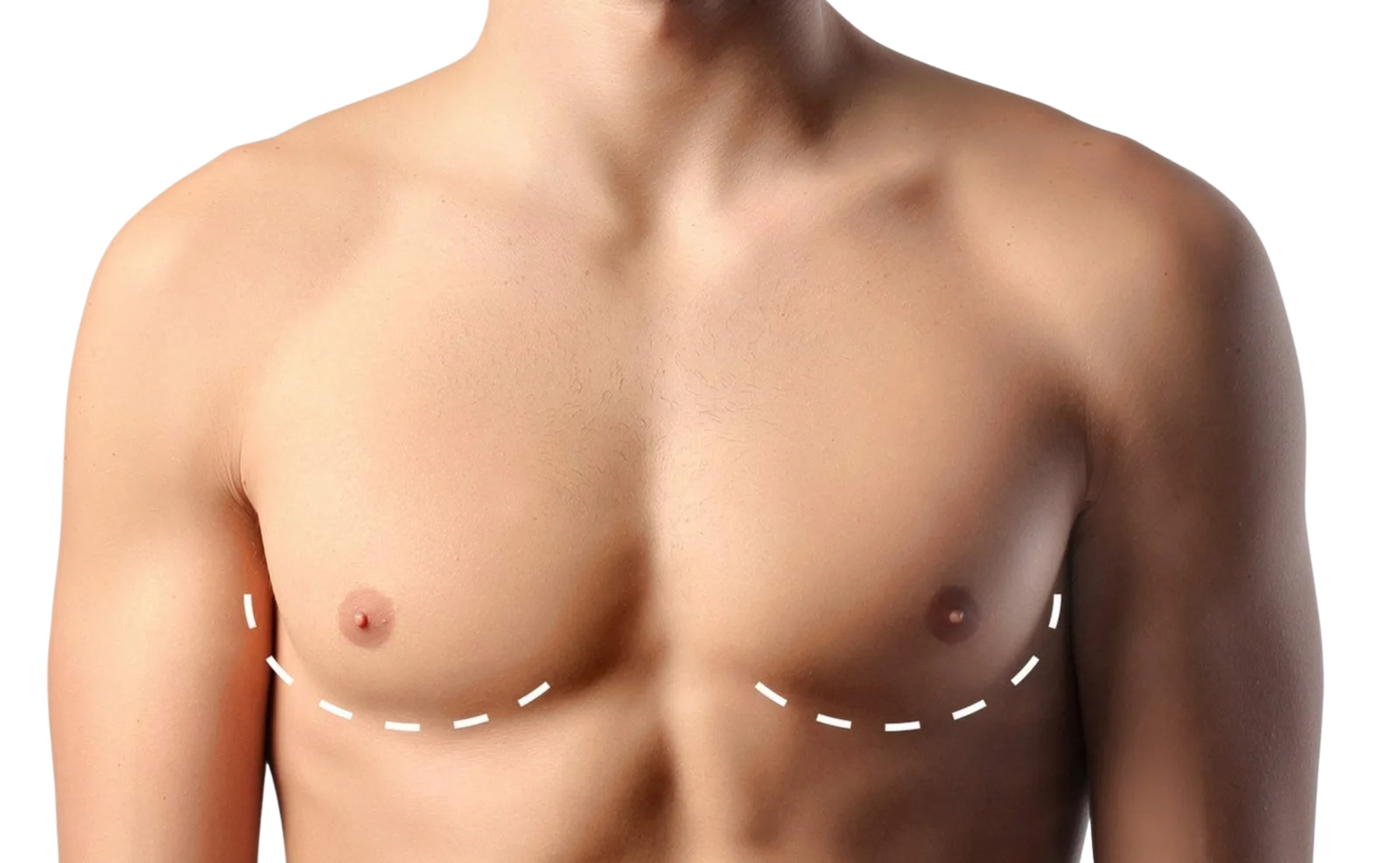 underarm hair removal