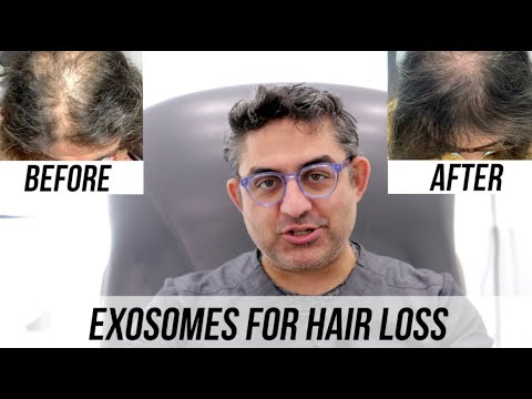Exosomes Hair Treatment