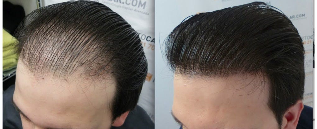 PRGF Hair Treatment