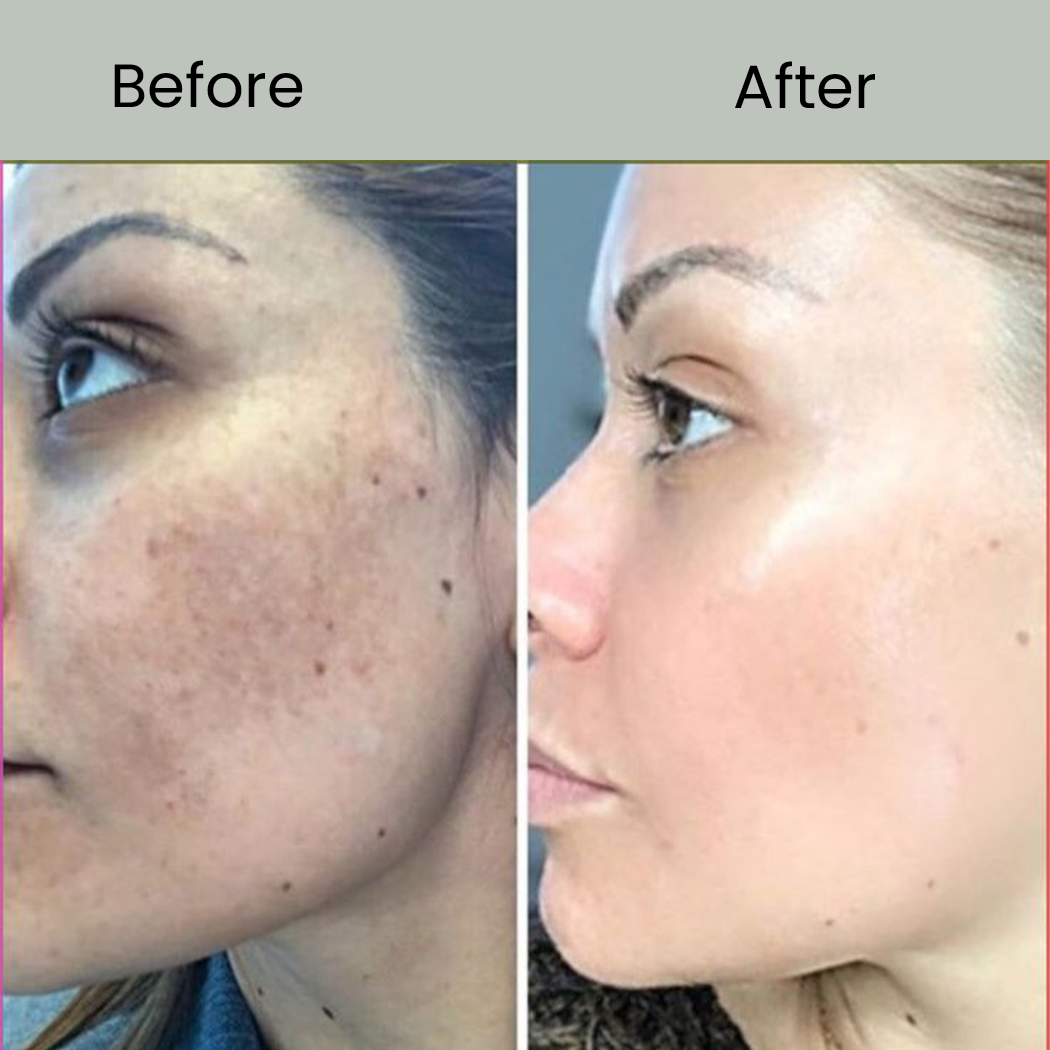 Best Face Pigmentation Solutions BEFORE AFTER ...