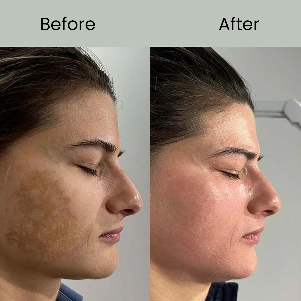 Best Face Pigmentation Solutions BEFORE AFTER