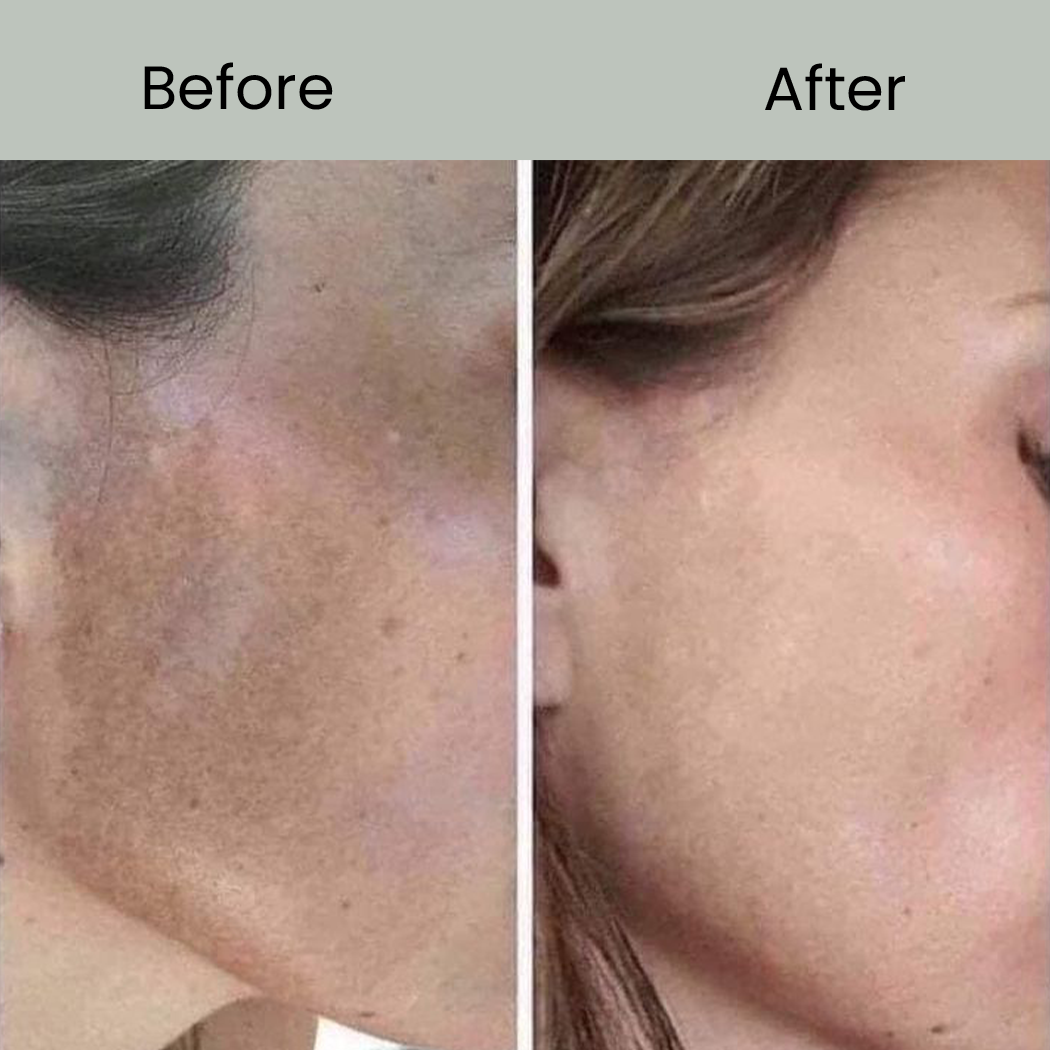 Best Face Pigmentation Solutions BEFORE AFTER..