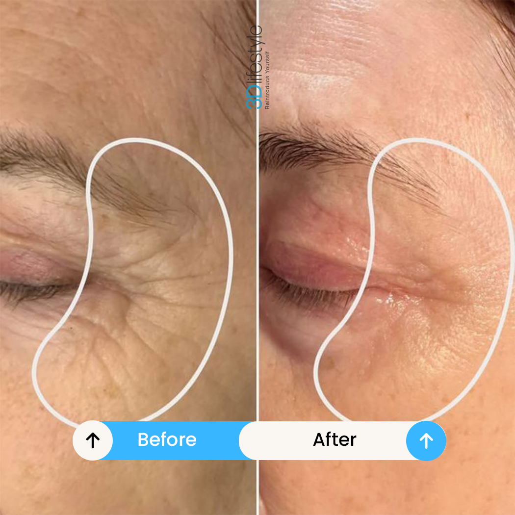 Best Profhilo Treatment before .after