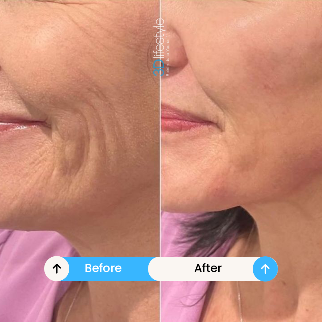 Best Profhilo Treatment before .after..