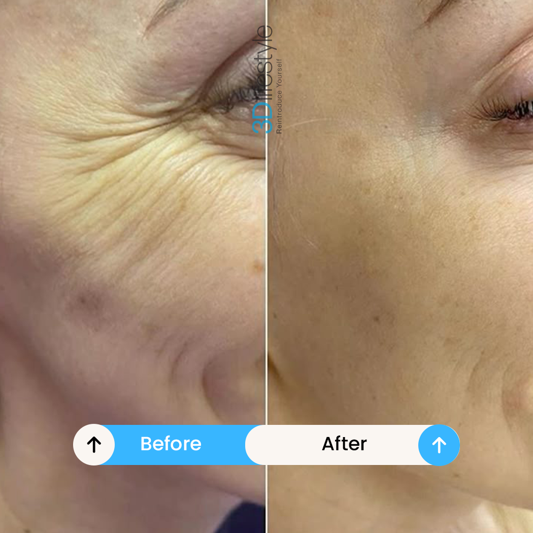 Best Profhilo Treatment before .after....