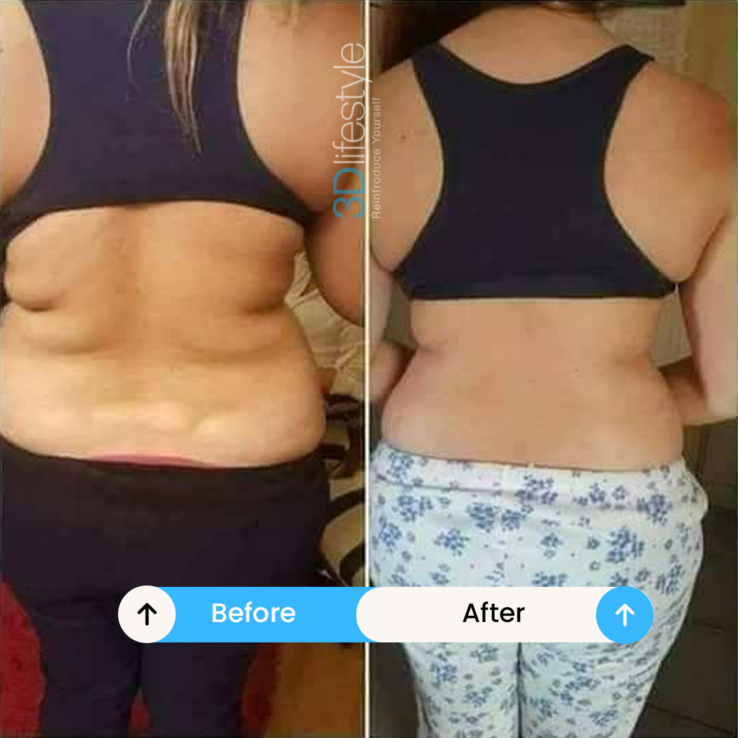 Body Contouring before .after