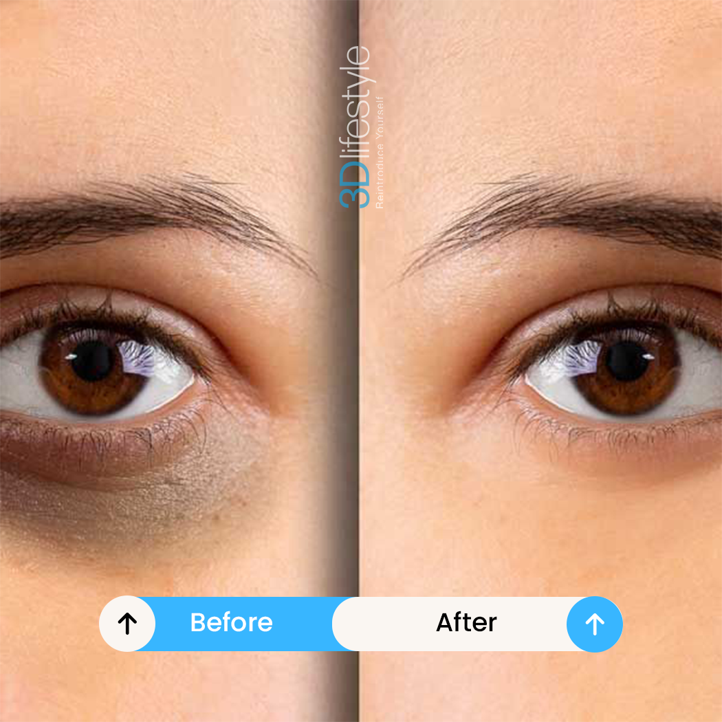 Dark Circle Treatment before .after